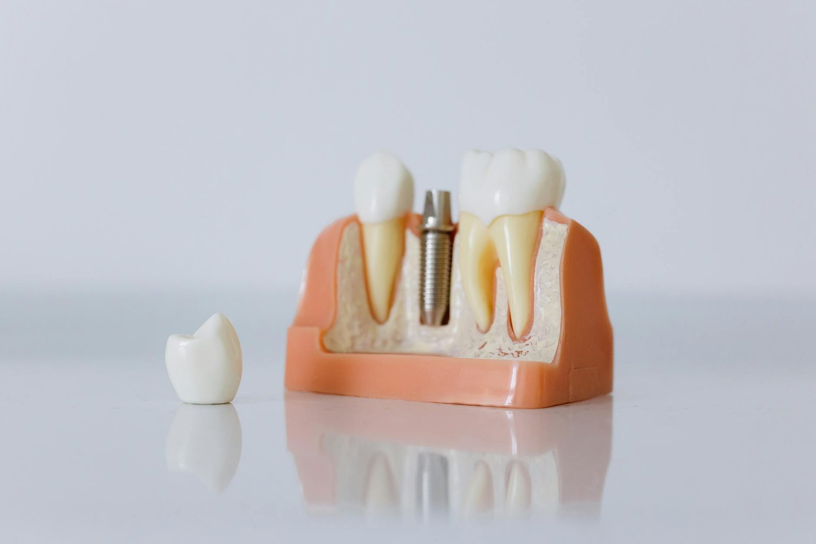 Illustration of Dental Implant Questions Hyderabad: Must-Have Answers from Best Dentist Jubilee Hills