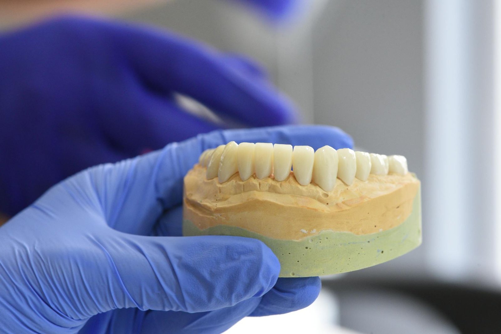 Illustration of Dental Implants for Missing Teeth: Best Affordable Dentist Near Jubilee Hills